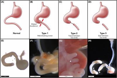 The Role of Fibroblast Growth Factor 10 Signaling in Duodenal Atresia